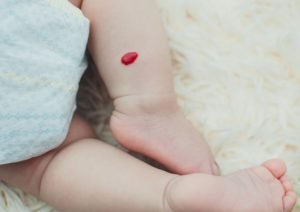 emangioma infantile