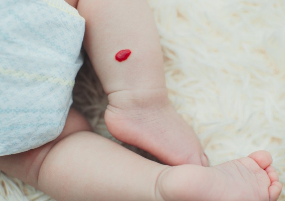 emangioma infantile